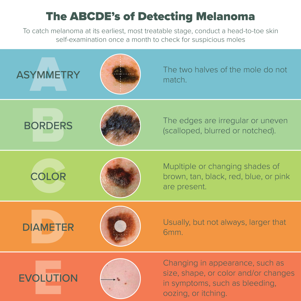 abcd melanoma