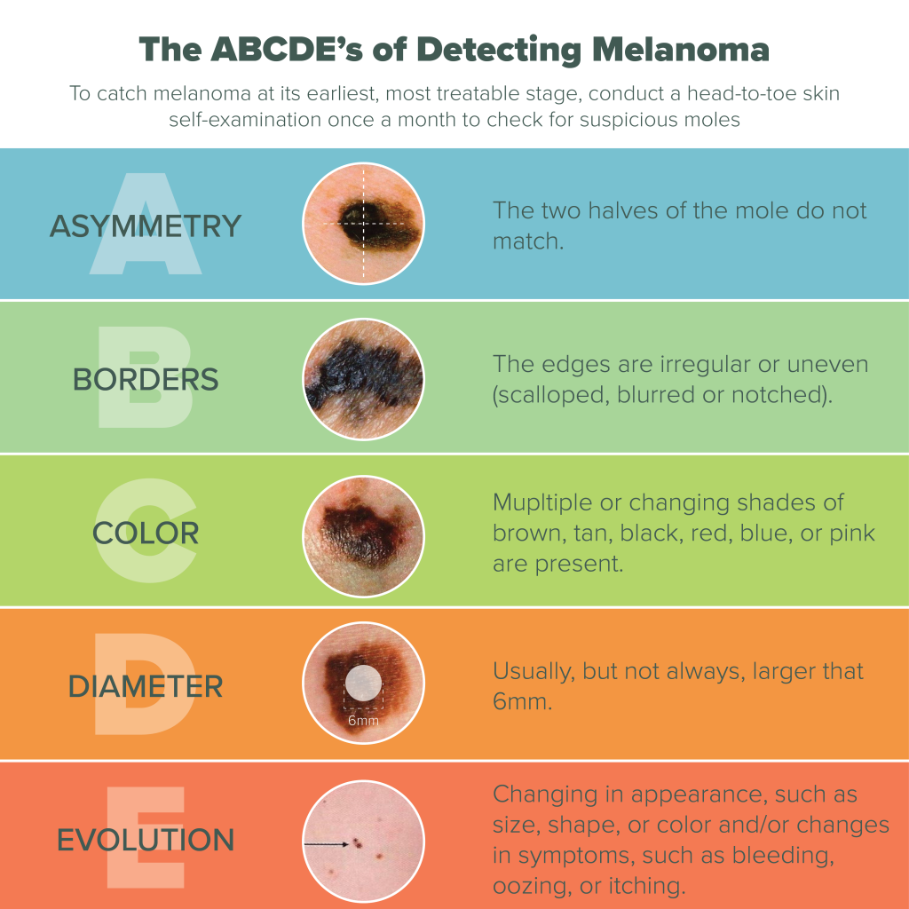 melanoma-pictures-on-legs-pictures-photos