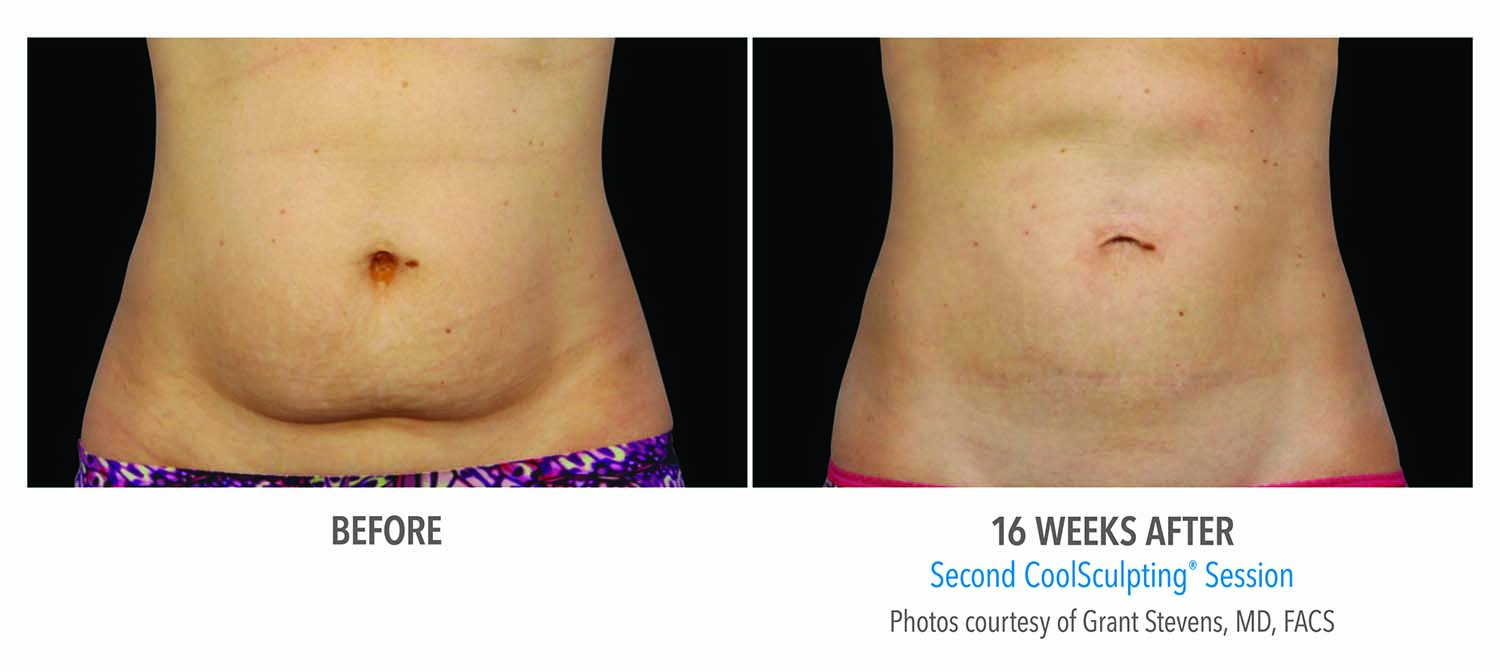 CoolSculpting Before and After - Female Abdomen