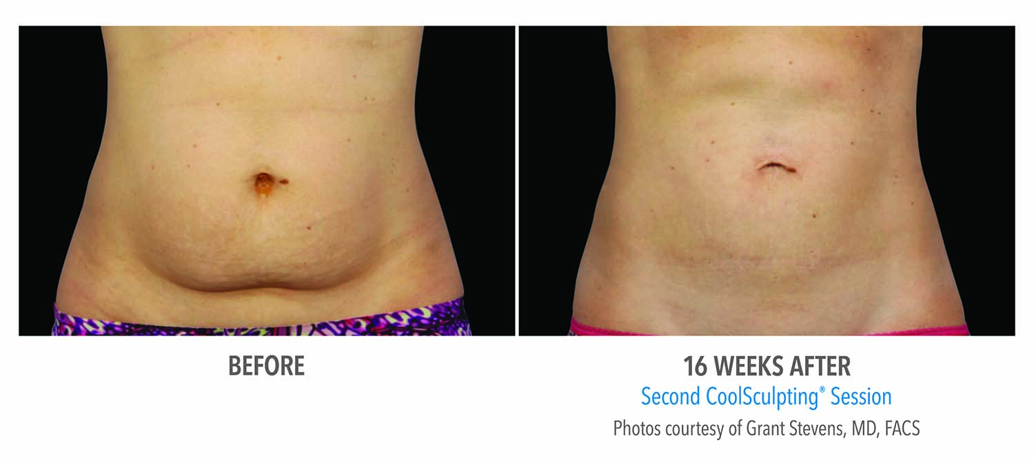 CoolSculpting Before And After Female Abdomen 5 