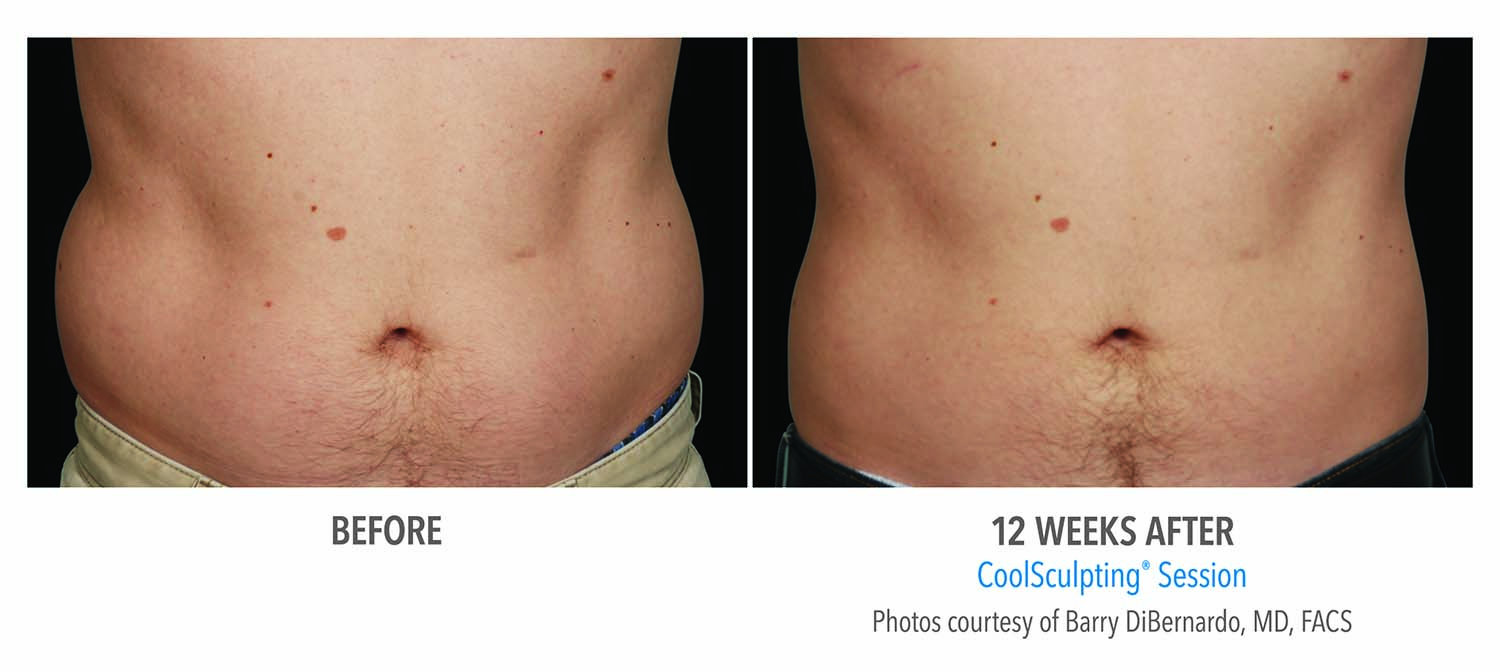 CoolSculpting Before and After - Female Abdomen