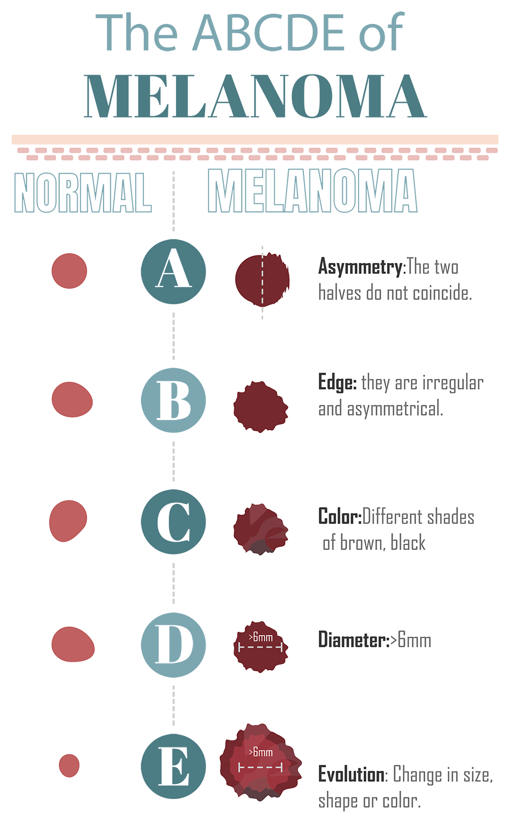 The ABCDE of Melanoma