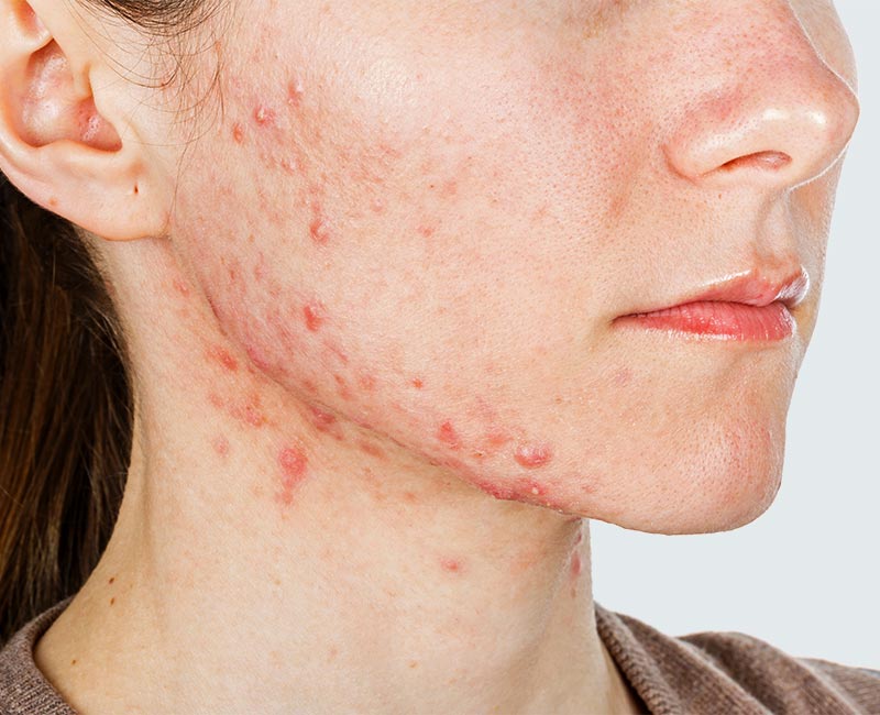 Acne treatment is available at Pure Dermatology & Aesthetics in Hoover, AL