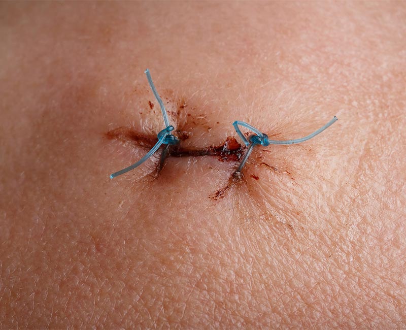 Biopsy Wound Care Instructions