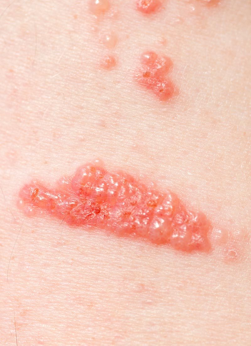 Contact Dermatitis treatment is available at Pure Dermatology & Aesthetics in Hoover, AL