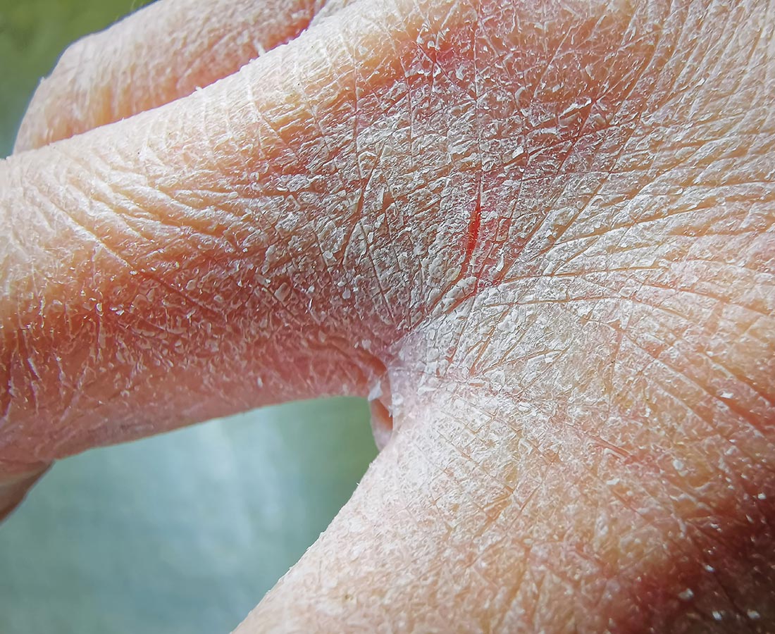 Dry Skin treatment is available at Pure Dermatology & Aesthetics in Hoover, AL