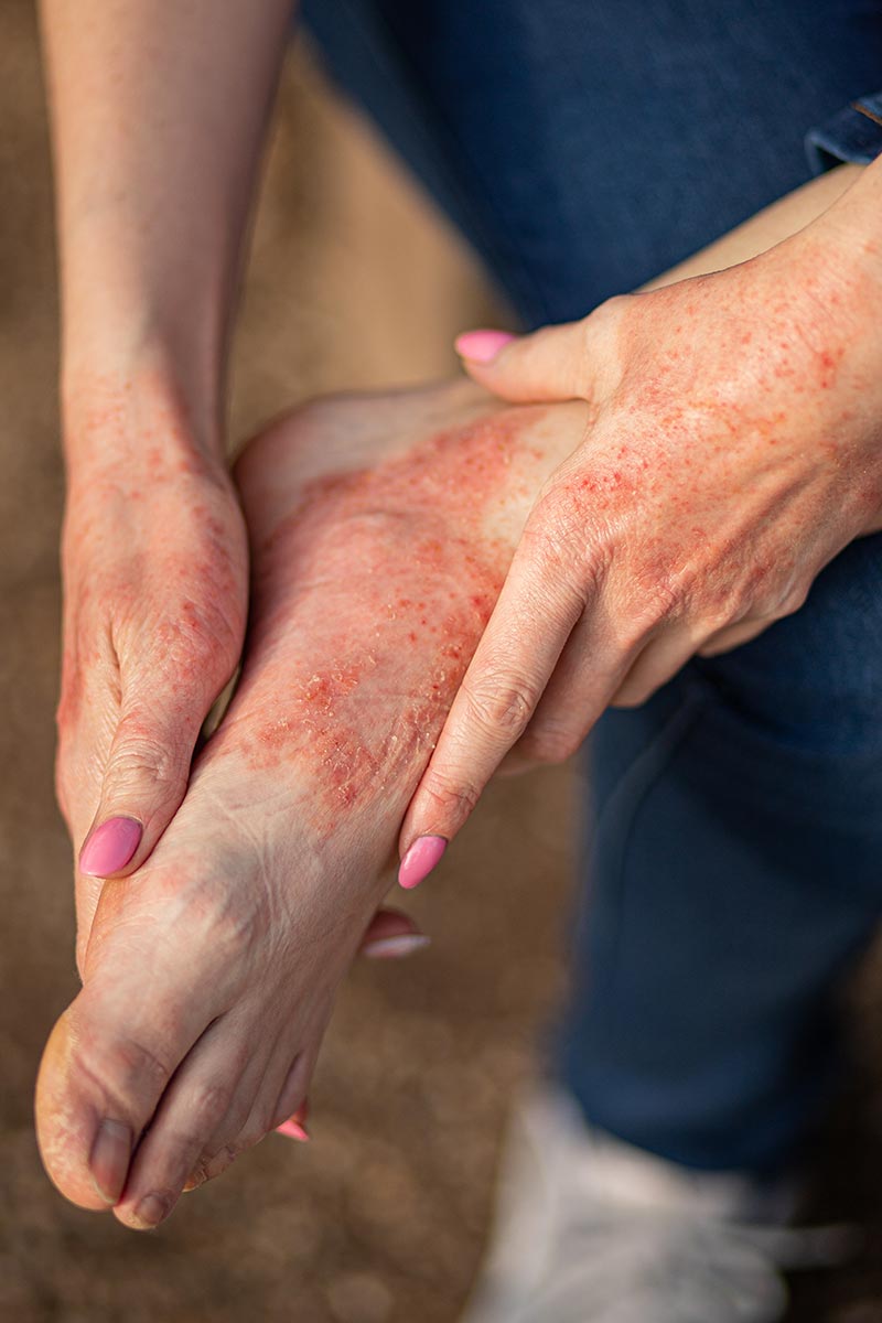 Eczema treatment is available at Pure Dermatology & Aesthetics in Hoover, AL