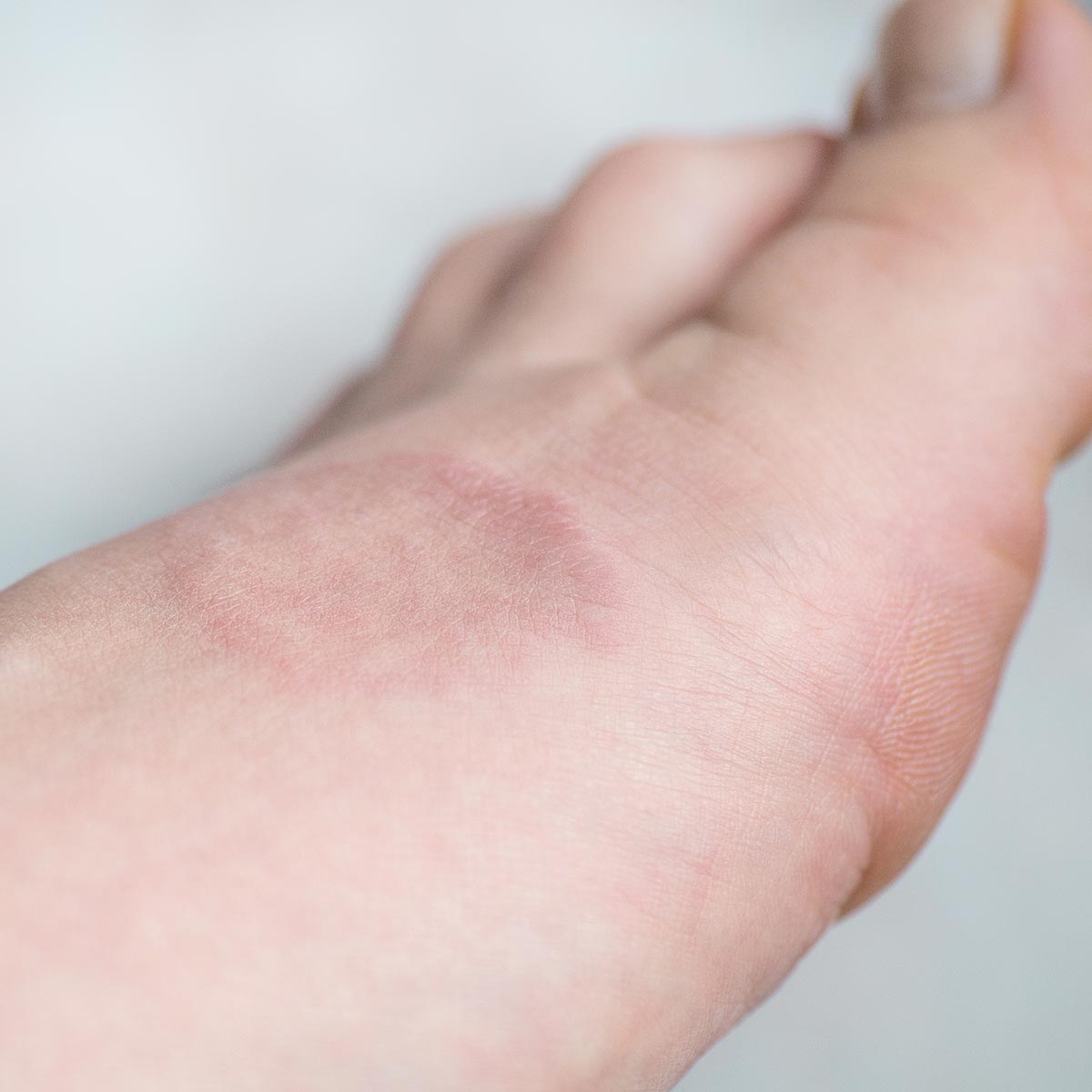 Granuloma Annulare treatment is available at Pure Dermatology & Aesthetics in Hoover, AL