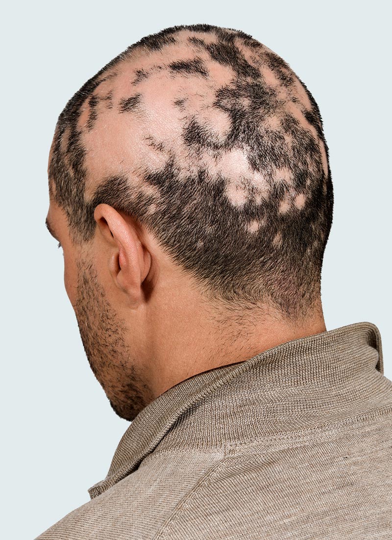 Hair Loss treatment is available at Pure Dermatology & Aesthetics in Hoover, AL