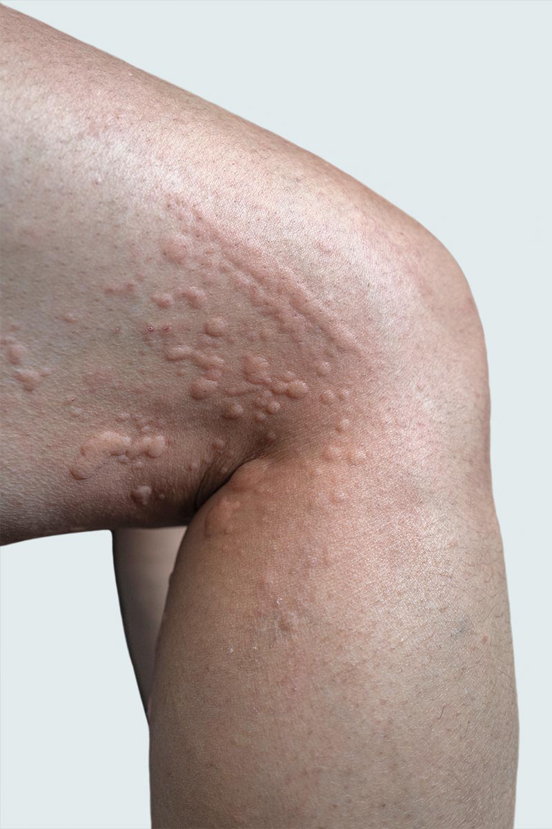 Hives treatment is available at Pure Dermatology & Aesthetics in Hoover, AL