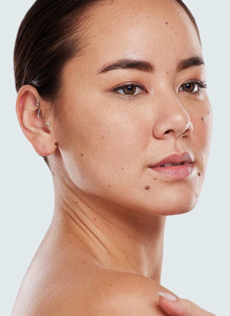 Moles treatment is available at Pure Dermatology & Aesthetics in Hoover, AL