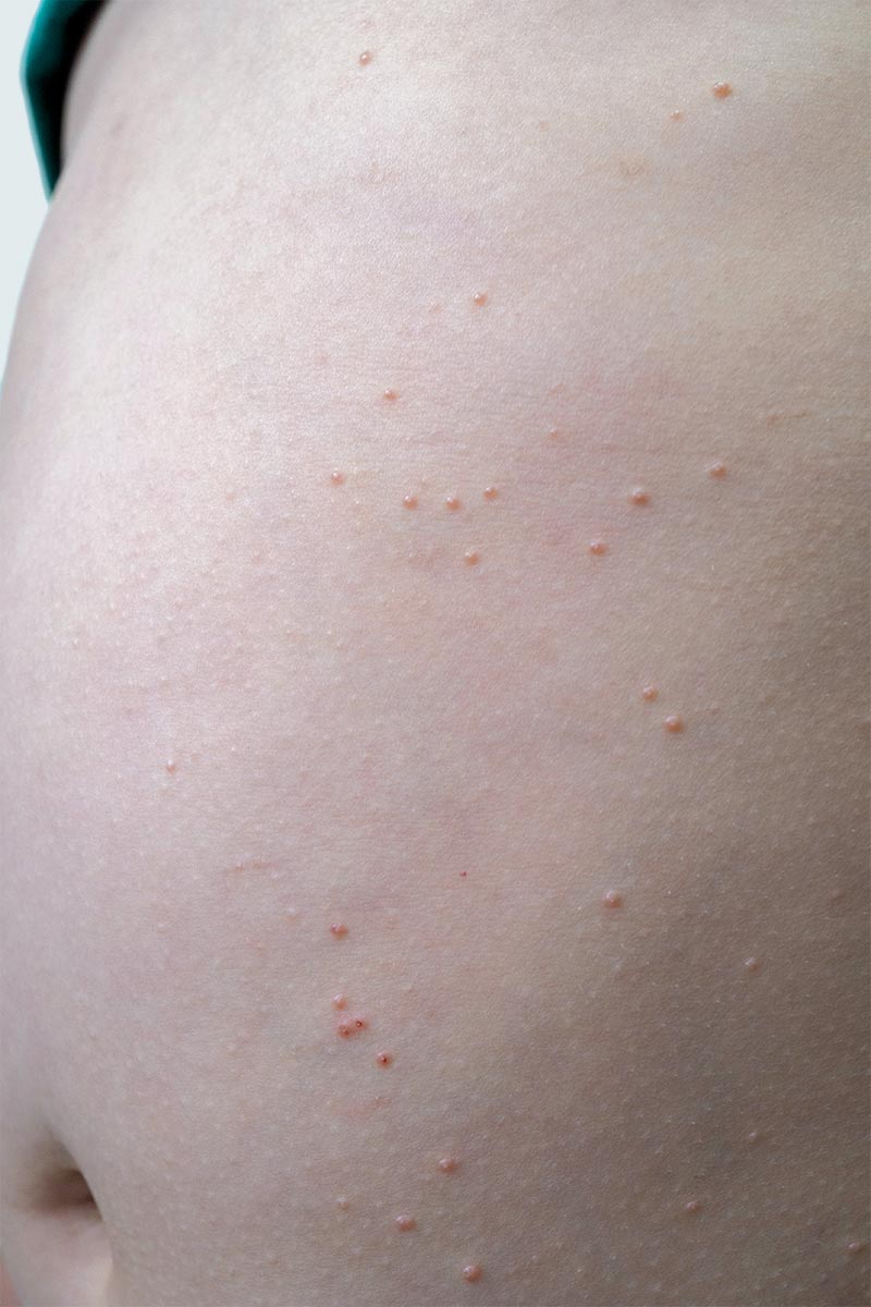 Molluscum treatment is available at Pure Dermatology & Aesthetics in Hoover, AL