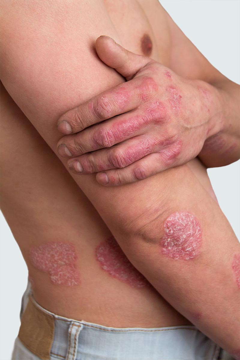 Psoriasis treatment is available at Pure Dermatology & Aesthetics in Hoover, AL