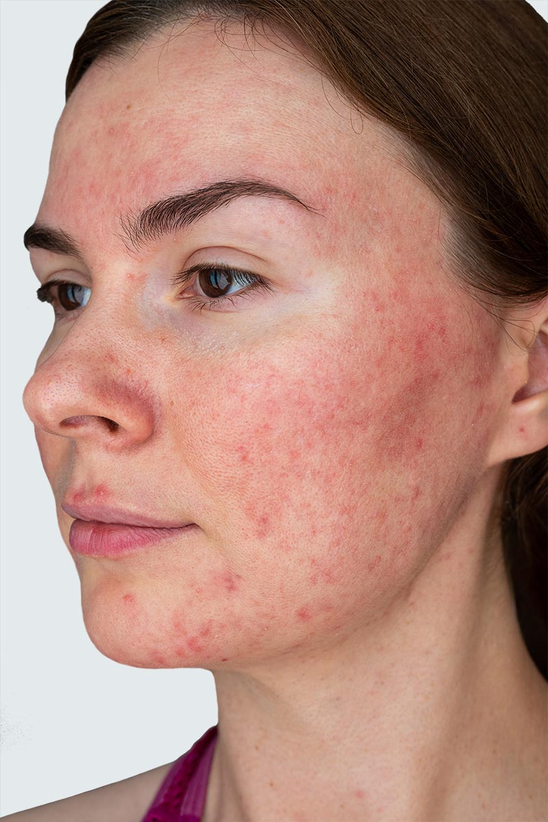 Rosacea treatment is available at Pure Dermatology & Aesthetics in Hoover, AL