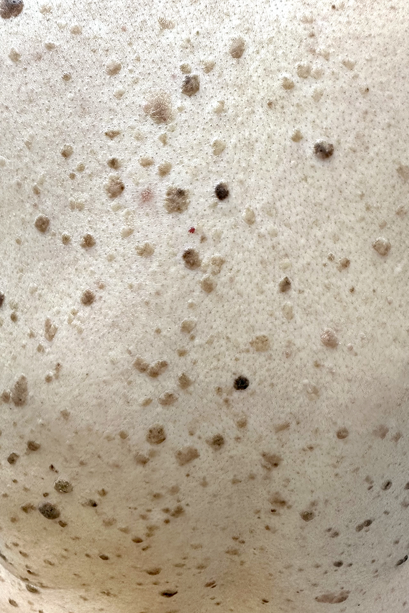 Seborrheic Keratoses treatment is available at Pure Dermatology & Aesthetics in Hoover, AL