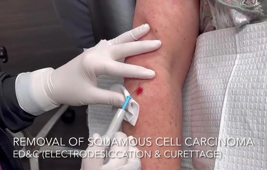 Surgical dermatology procedures available at Pure Dermatology & Aesthics