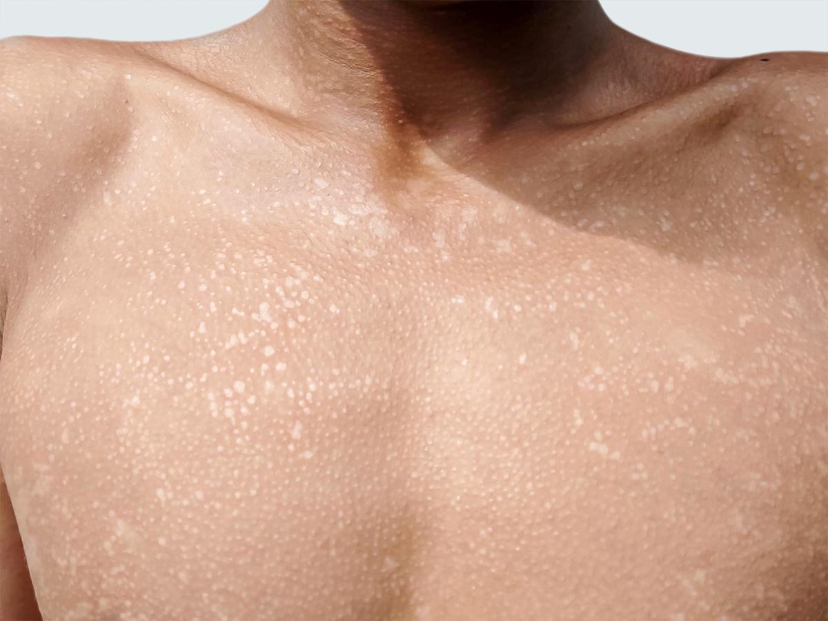 Tinea Versicolor treatment is available at Pure Dermatology & Aesthetics in Hoover, AL