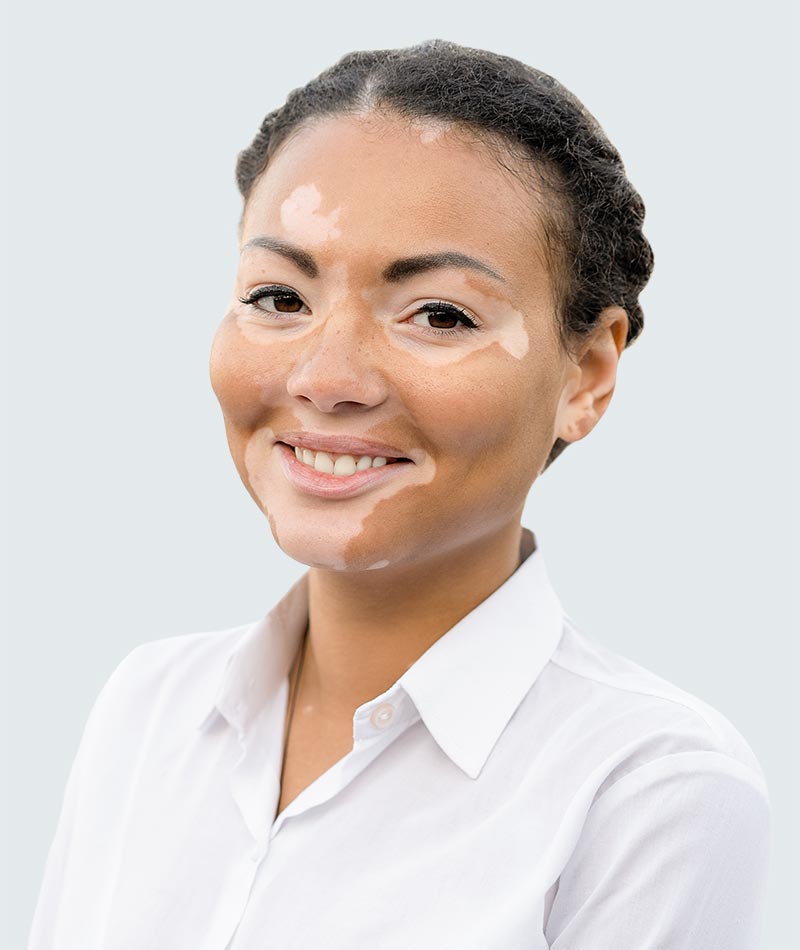 Vitiligo treatment is available at Pure Dermatology & Aesthetics in Hoover, AL