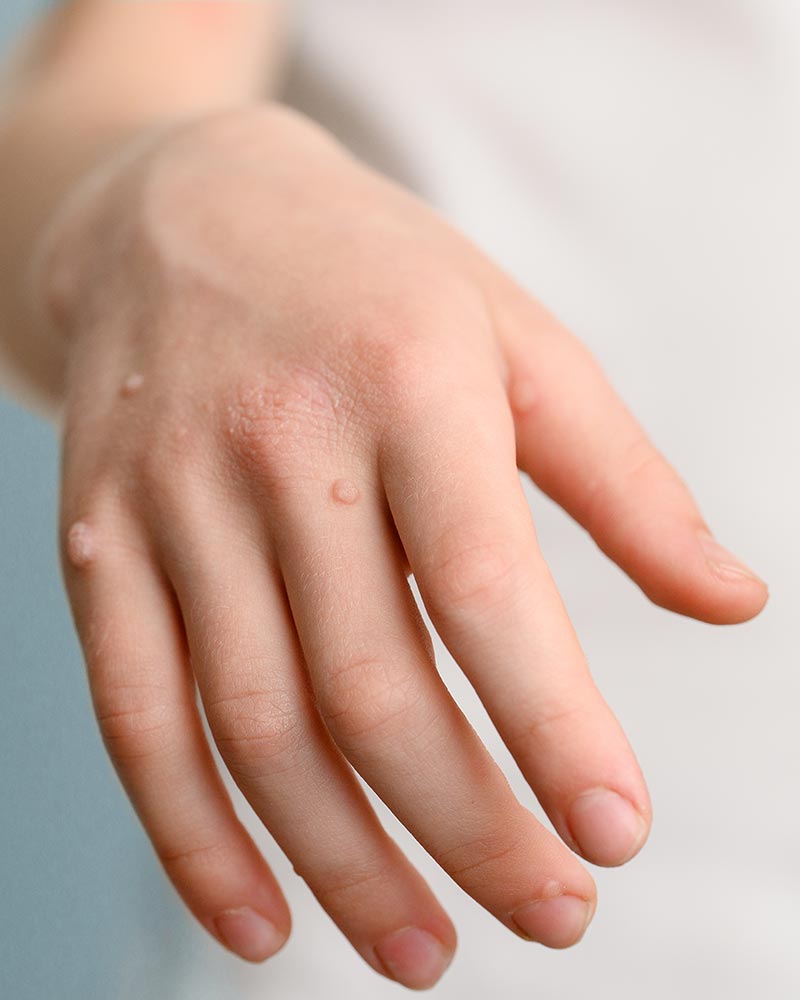 Warts treatment is available at Pure Dermatology & Aesthetics in Hoover, AL